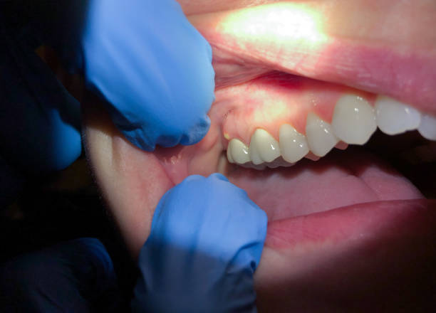 Best Emergency Wisdom Teeth Removal in Lexington, SC