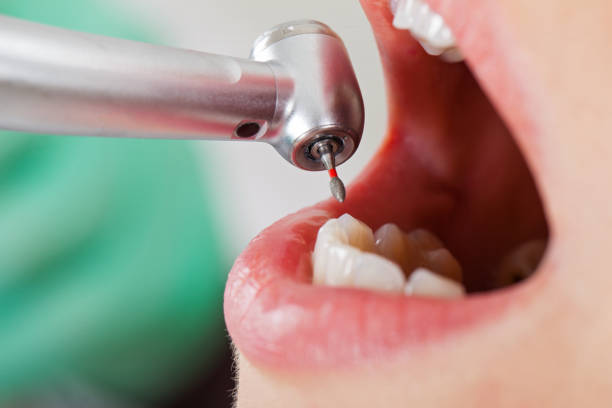 Best Emergency Treatment for Toothache in Lexington, SC